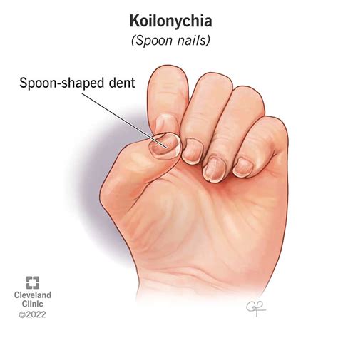 koilonychia pronunciation|koilonychia anemia.